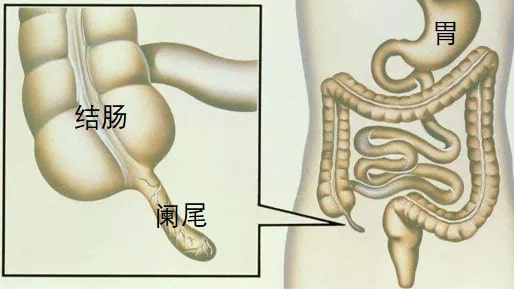 小儿阑尾炎怎么办